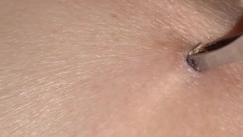 Blackhead removal video best