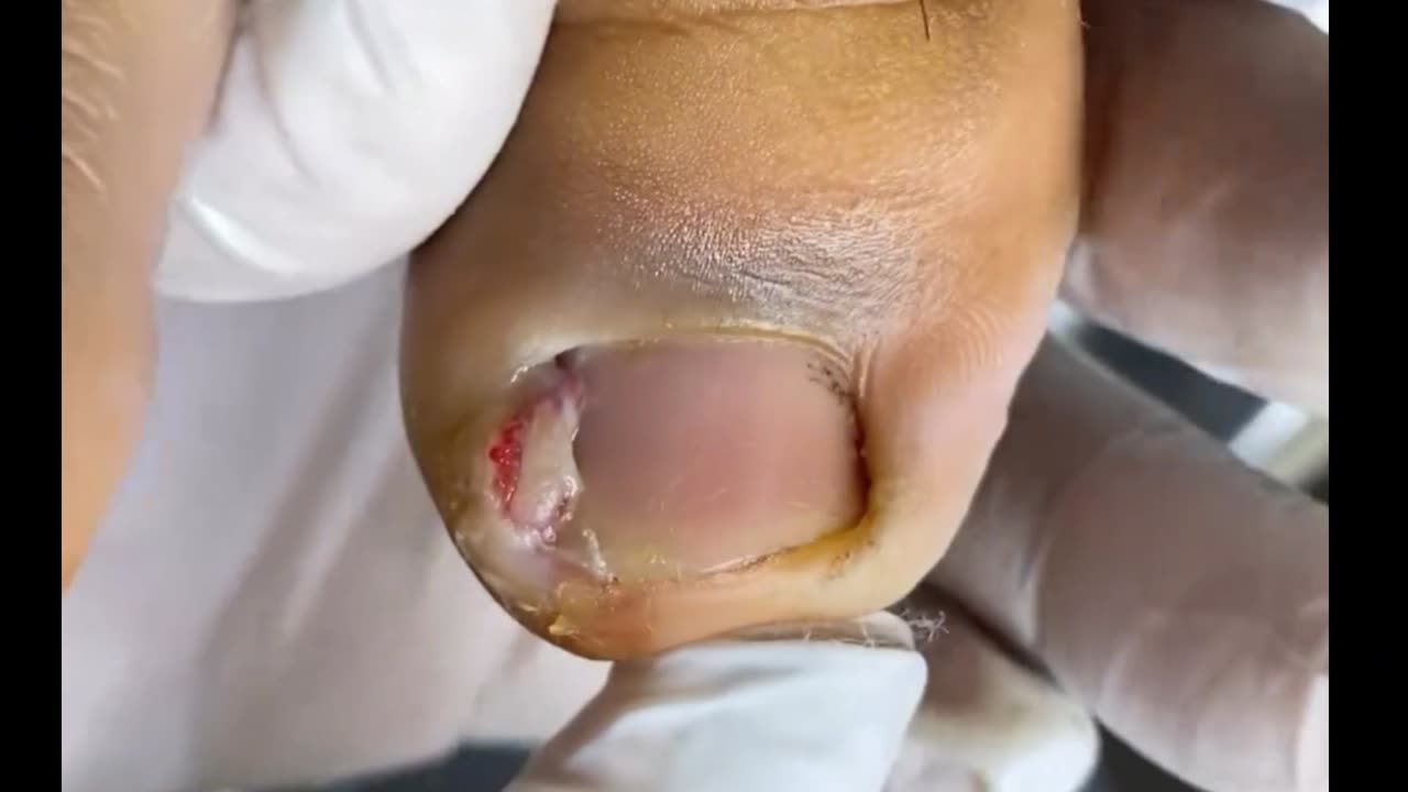 Ingrown toenail removal 003