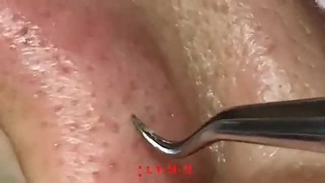 Removal Of Blackheads On The Nose Smooth