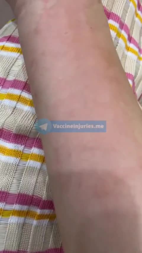 Moderna Vaccine Reaction