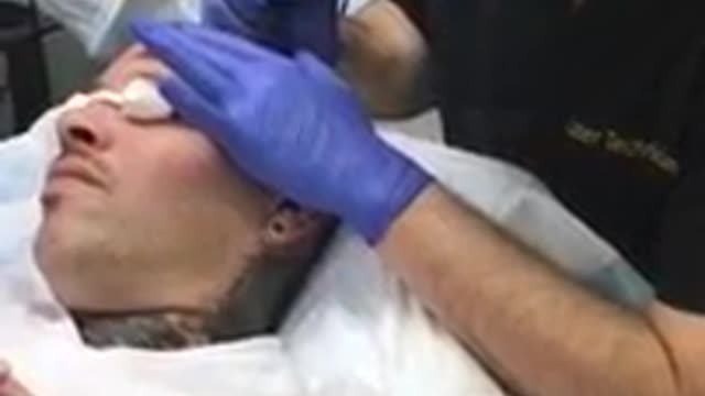 Scalp Micro Pigmentation Philadelphia - Scalp Micro Pigmentation NYC