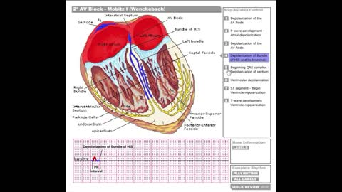 Dr Stanley's ECGcourse.com | Second Degree AV Block, Mobitz I (Wenckebach)