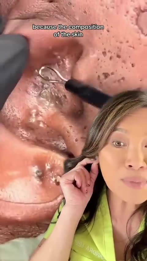 Did you know that nose skin is very skmilar to ear skin in skin composition？