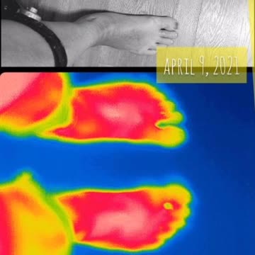 Biomagnetism's effect on atrophied right foot, with photos before, after