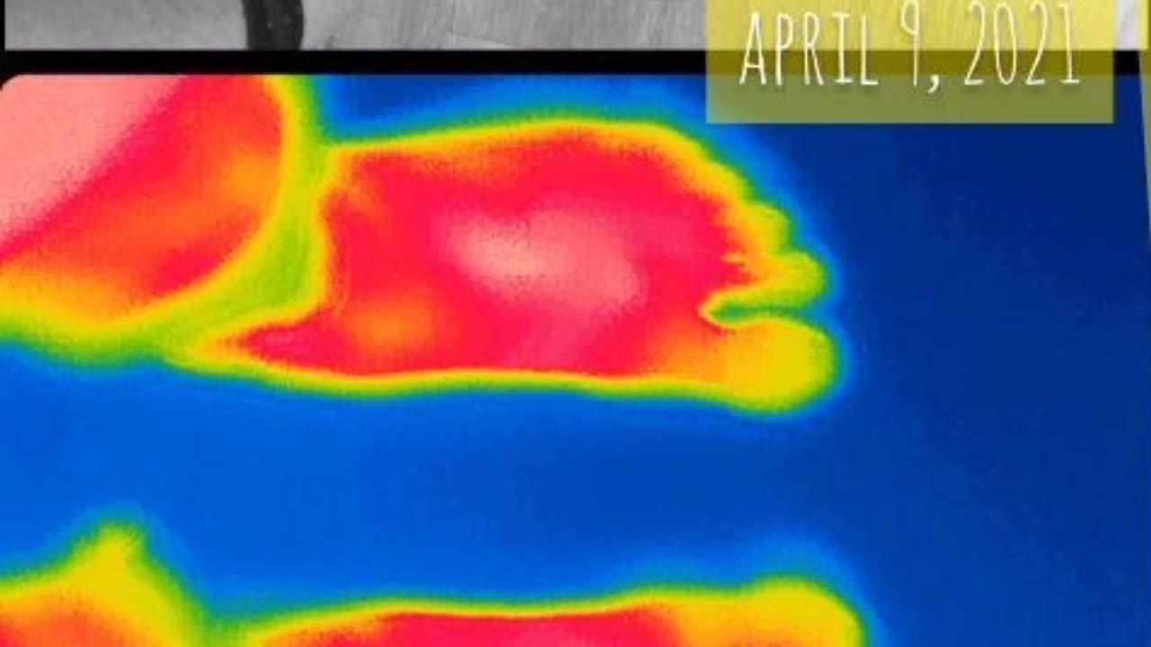 Biomagnetism's effect on atrophied right foot, with photos before, after