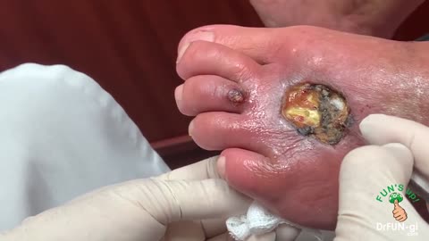 This Is What Happens When A Poisonous Spider Bites Your Foot!!