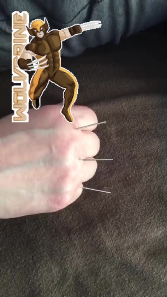 judith's acupuncture experience