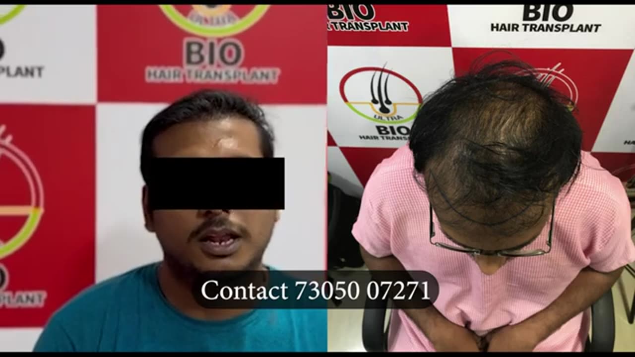 3 month hair transplant results | before and after