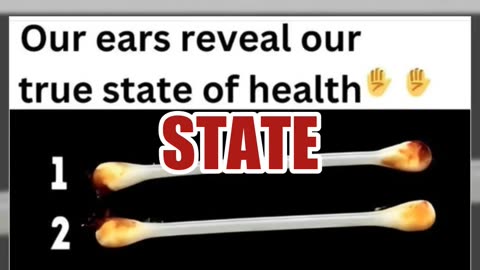 Fact Check: Earwax Color Does NOT Reveal 'True State' Of Your Health