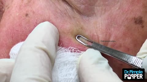 Short but Sweet Blackhead Extractions with Dr Pimple Popper