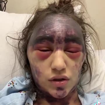 Update of the female that is having horrific reaction to “vaccines” administered all at one visit