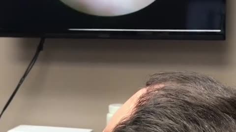 Ear cleaning part 1