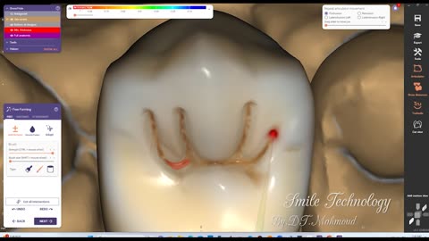 #design #naildesign #dental #dentaldesign #exocadexpert