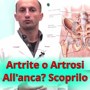 Dolore all'Anca: Differenze tra Artrite e Artrosi