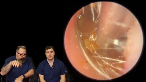 TRICKY EAR WAX REMOVAL BY CURETTAGE - EP3