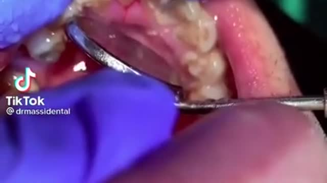 Tartar Dentist 2021 | Satisfying Dental-work