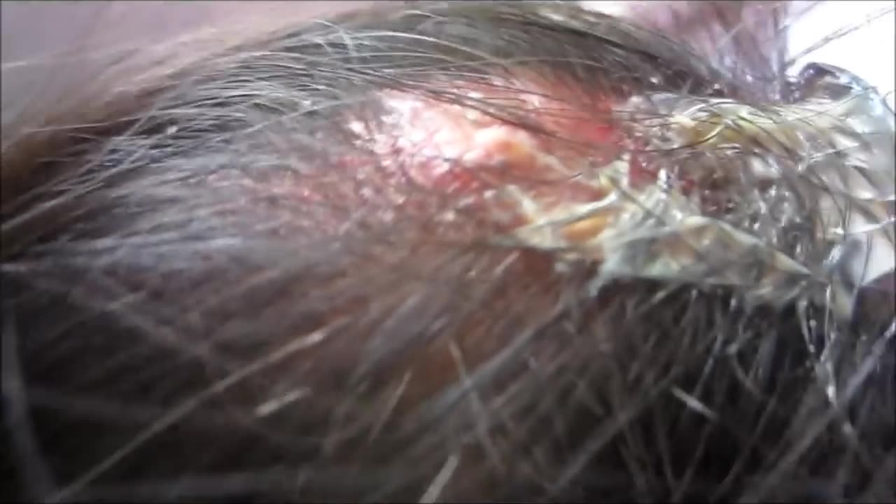 Scalp Abscess