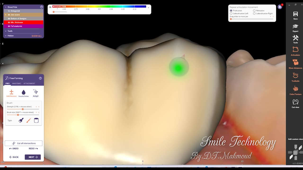 #design #naildesign #dental #dentaldesign #exocadexpert