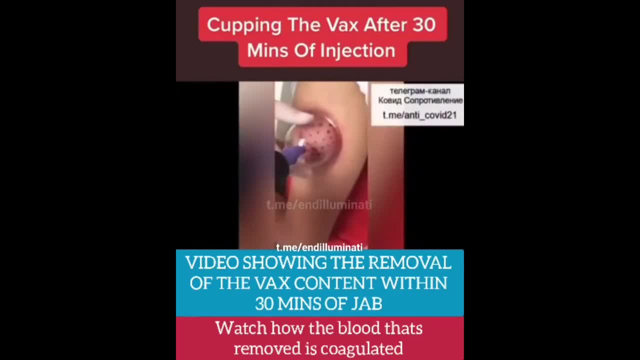 Blood was removed from the jabbed area of the arm within 30 minutes of shot!