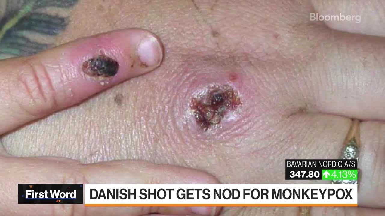 Monkeypox Vaccine From Denmark Wins EU Approval