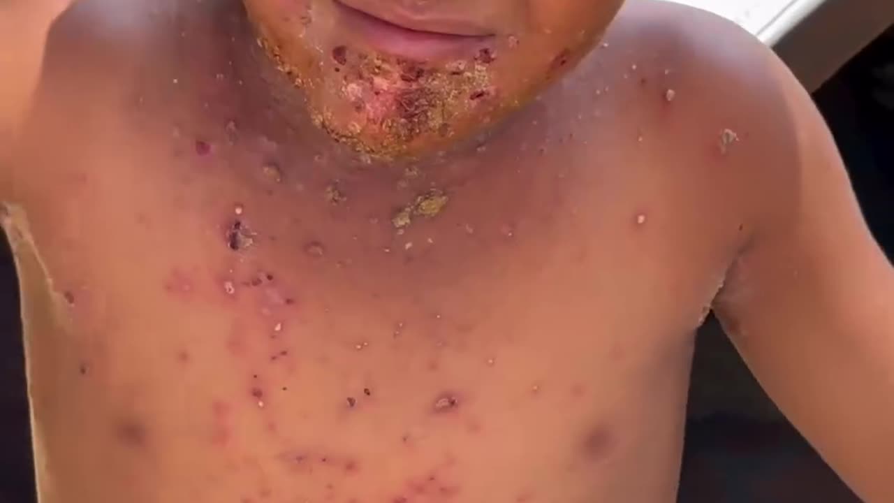 Serious skin diseases are spreading rapidly among children