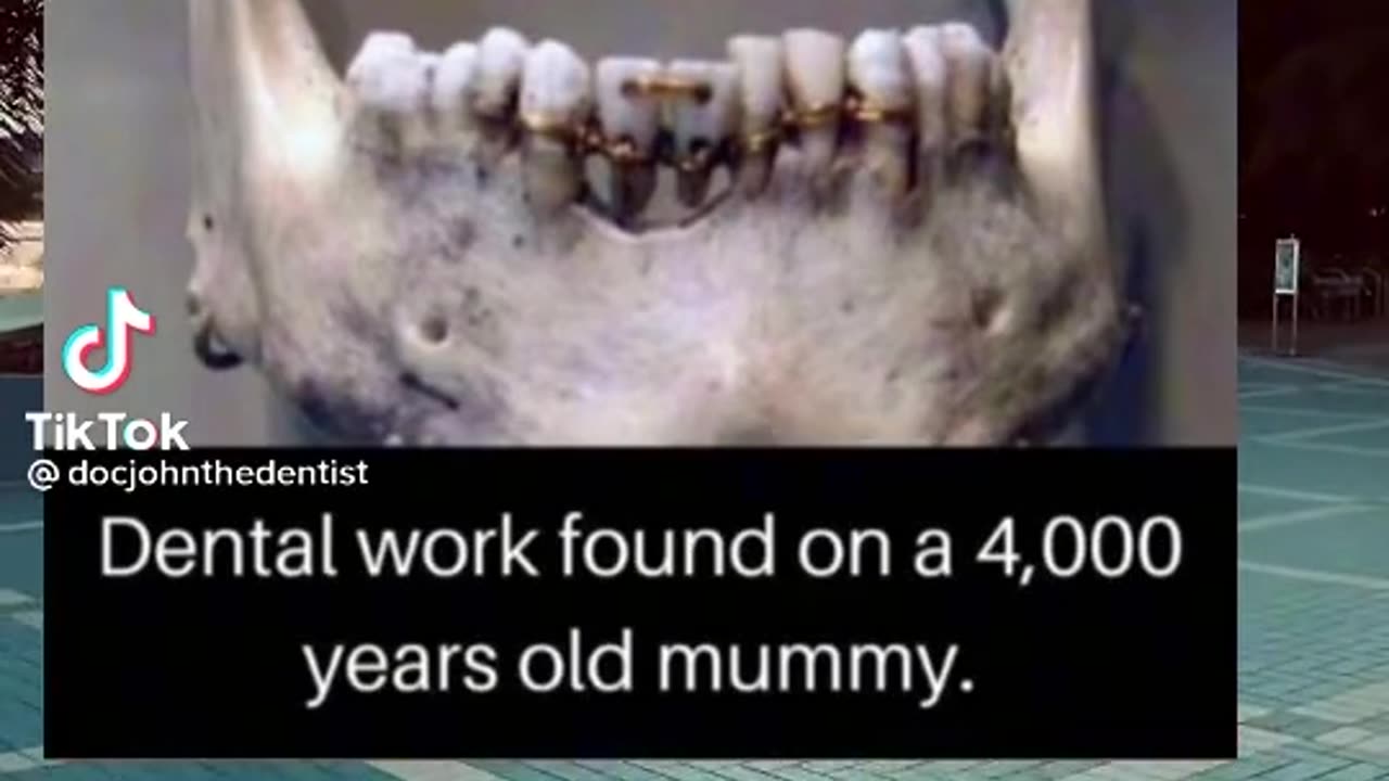 DENTAL WORK FOUND ON A 4,000 YR OLD MUMMY ~ANCIENT FIXED BRIDGE