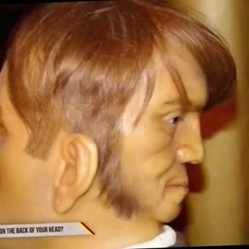 The rare Conjoined twines