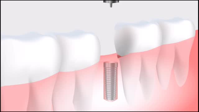 How to do Tooth Implant || how do tooth Implant || H4R