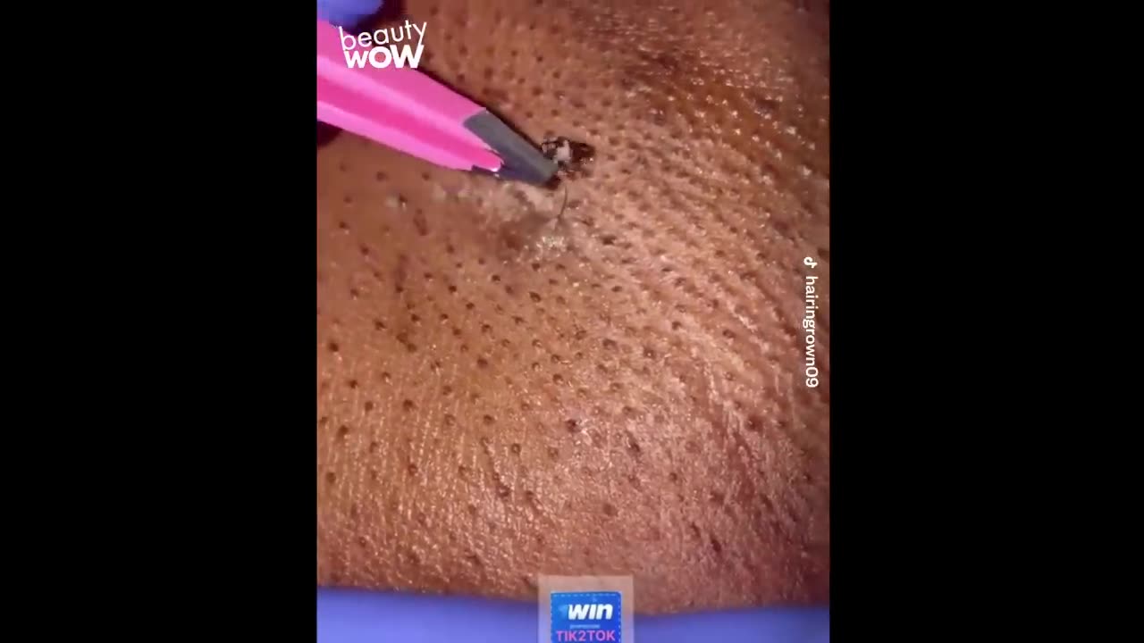 Satisfying Ingrown Hair Removal Compilation