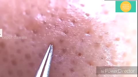 Popping blackheads