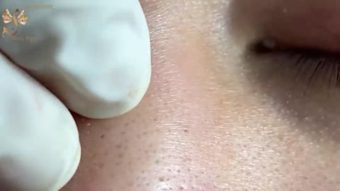 #123 | Acne Treatment Huong beauty | Part 2