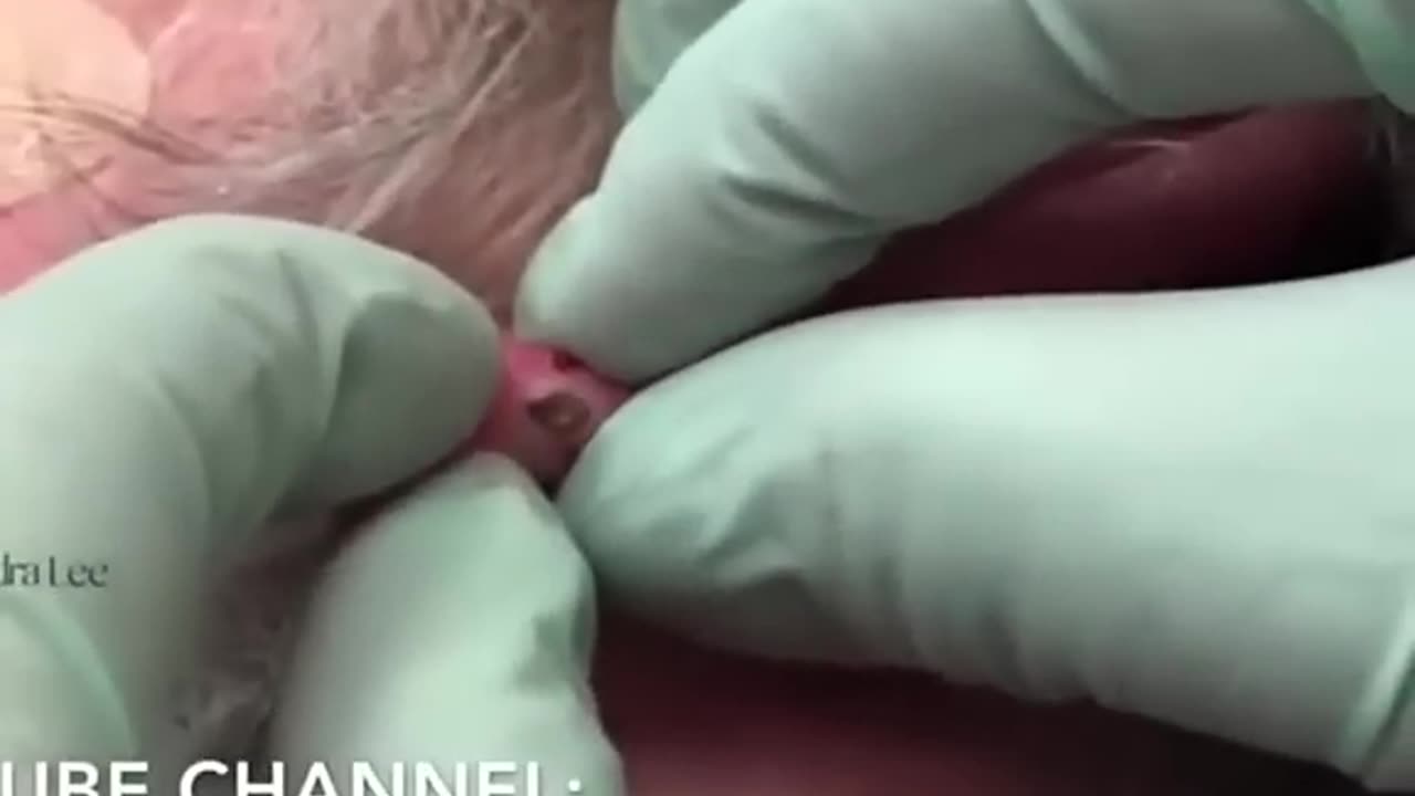 Ear blackheads are the best kind… #drpimplepopper compilation