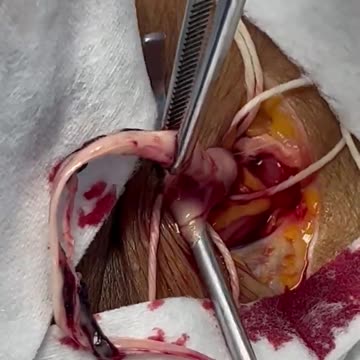 WATCH: Covid-19 Side Effect - A strange white fibrous clot is removed from the right jugular vein