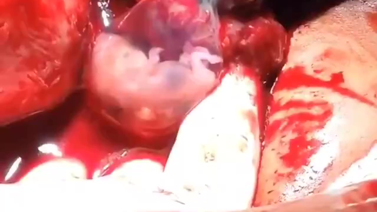 Vide Shows Unborn baby is a Human Being!