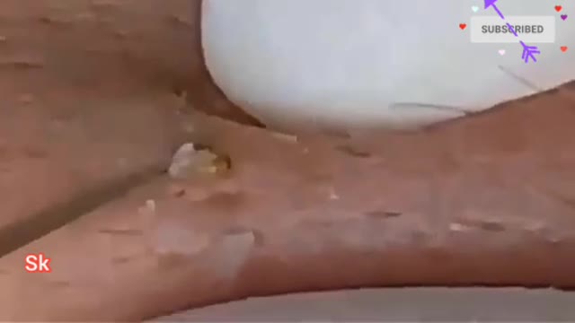 Pimple popper blackheads Removal