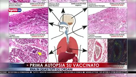 Prima autopsia a un vaccinato dimostra che il vaccino non ha fermato il decorso del Covid