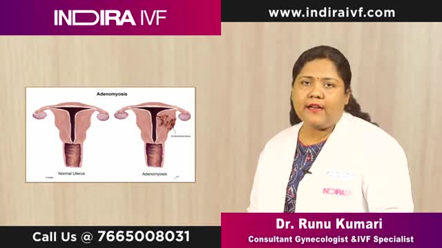 Adenomyosis: Know What is Adenomyosis Uterus at Indira IVF