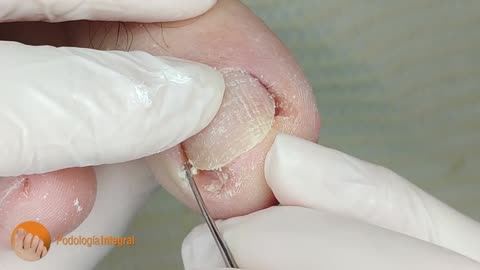 Juicy and Infected ingrown toenail