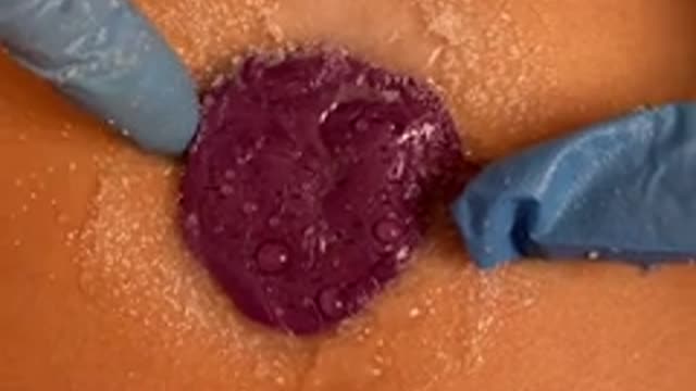 Belly Buildup Removal