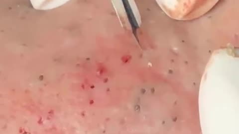 pimple popping