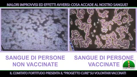 Sangue delle persone vaccinate al COVID al microscopio