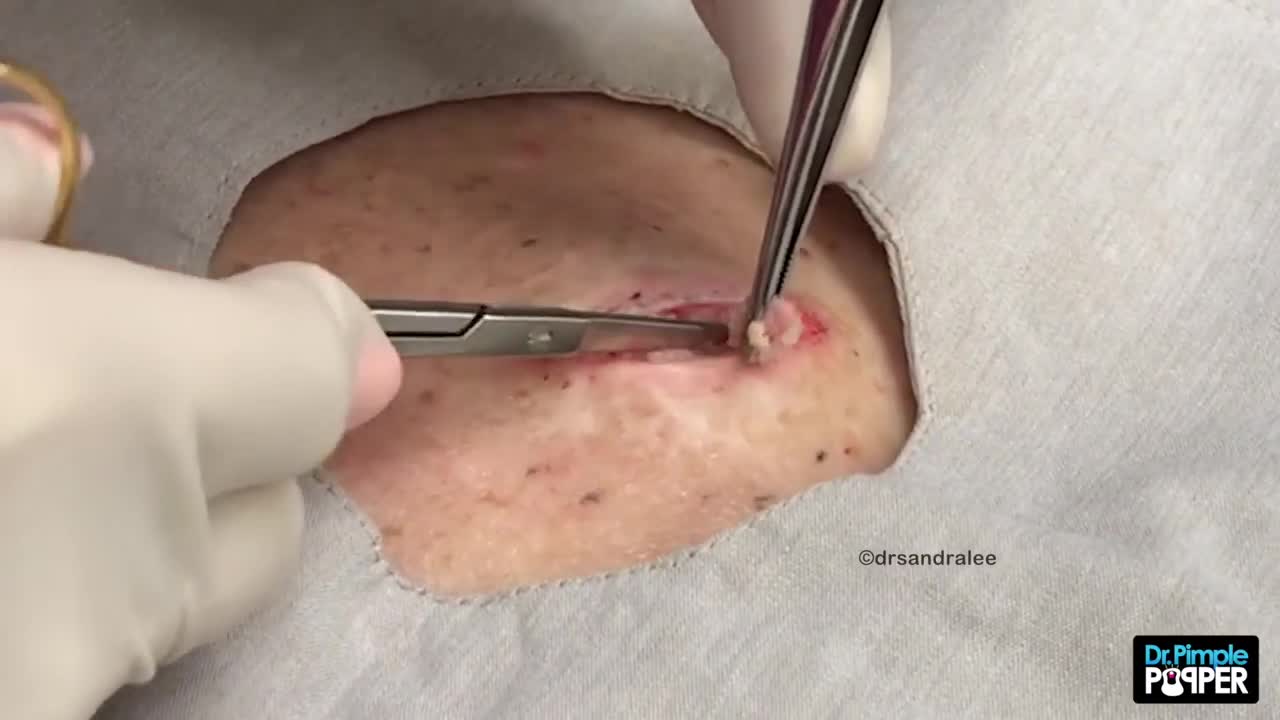 An Apple Cider Cyst That Goes On and On...