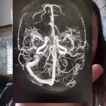 תופעת לוואי קרישי דם במוח לאחר 2 חיסונים של פייזר