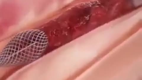 Remove Blood Clot In Heart