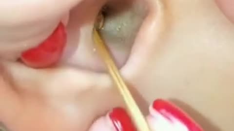 gigantic ear wax removal #47