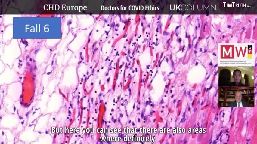 Pathology is the way to determine who is dying of what from vaccines!