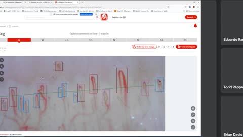Nailfold Capillaroscopy Software Demo