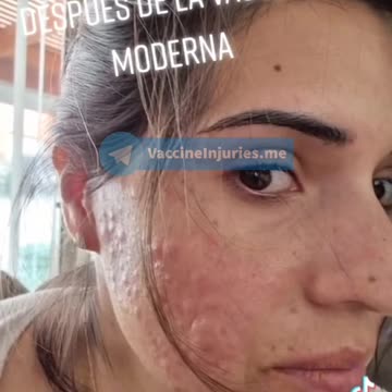 Moderna vaccine reaction