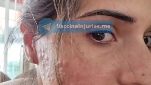 Moderna vaccine reaction