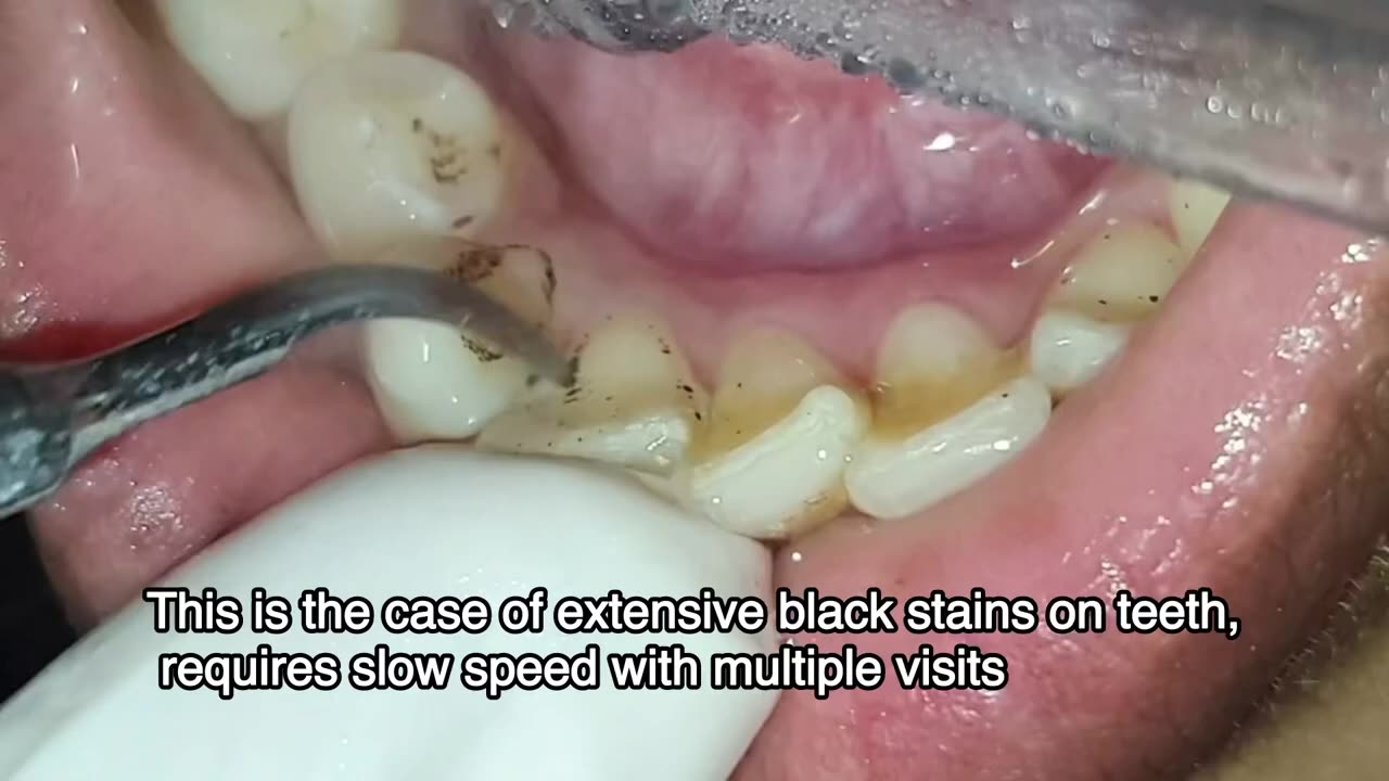 Scalling & polishing of your teeth procedure